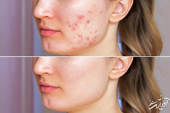 سیب زمینی برای جوش 